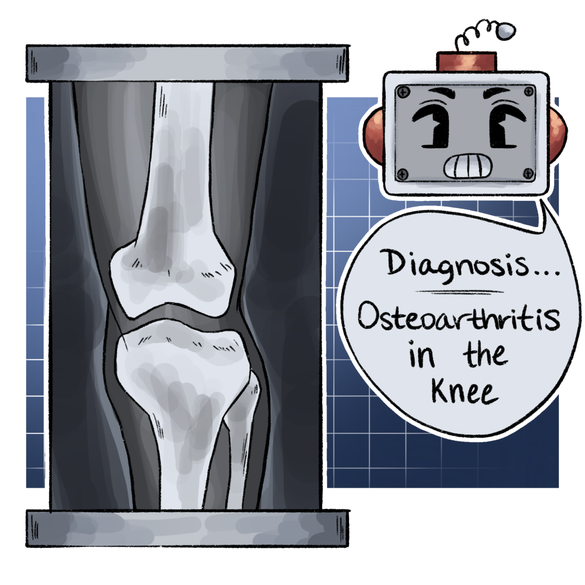 Researchers train AI model to diagnose knee osteoarthritis with clinical-grade performance